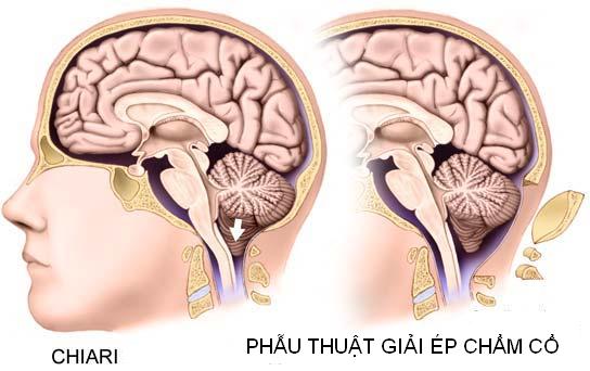 Chiari Malformation - Hình ảnh minh họa